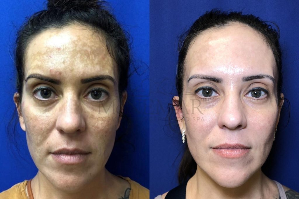 before and after image of a female client that received a pigmentation treatment
